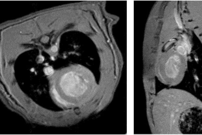 MRI image of a heart